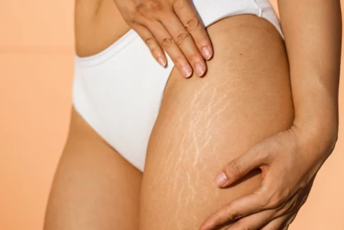 Stretch Marks: Causes and Remedies